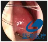 等離子刀頭